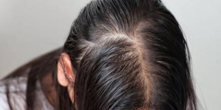 وصفة الزيوت الطبيعية لتقليل الصلع وتحفيز نمو الشعر