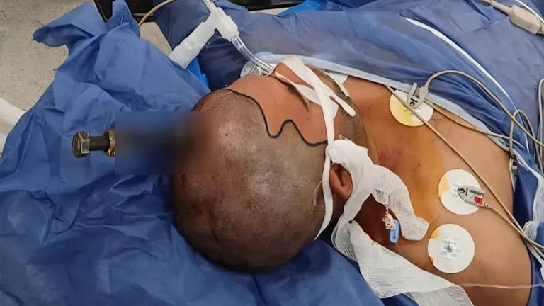قصر العيني ينقذ مريضًا من مسمار اخترق الجمجمة بالقرب من شرايين المخ